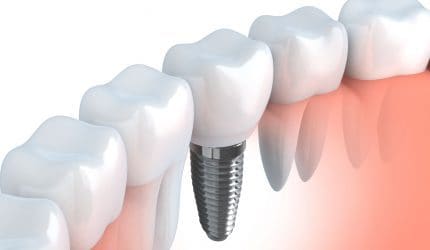 implant dentaire montreux implant dentaire montreux